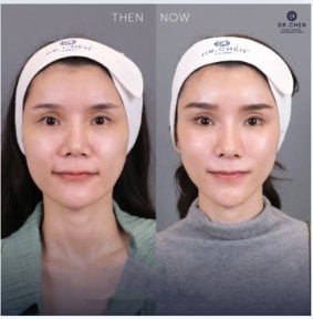 Ultherapy Vorher-Nachher-Ergebnis bei Dr. Chen Clinic – sichtbare Hautstraffung im Gesicht