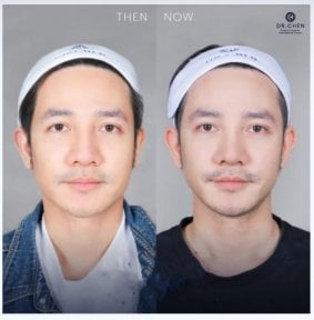 Ultherapy Vorher-Nachher-Ergebnisse in der Dr. Chen Clinic – sichtbare Hautstraffung