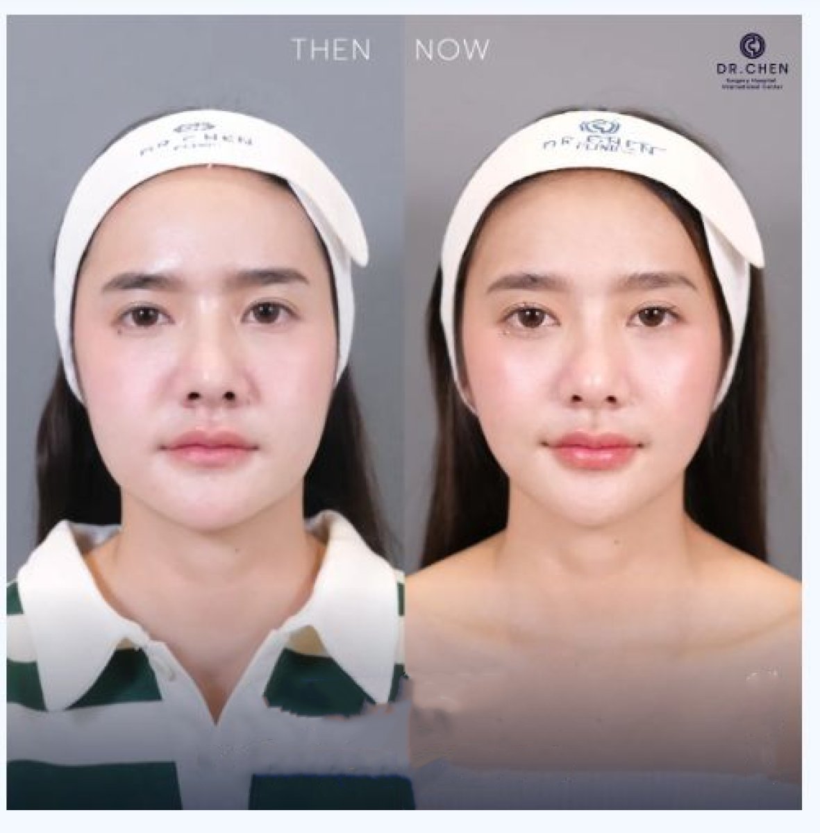نتائج قبل وبعد علاج Ultherapy في عيادة Dr. Chen – شد واضح لبشرة الوجه