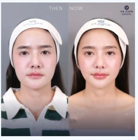 Ultherapy Vorher-Nachher-Ergebnis bei Dr. Chen Clinic – sichtbare Hautstraffung im Gesicht