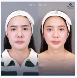 Ultherapy Vorher-Nachher-Ergebnis bei Dr. Chen Clinic – sichtbare Hautstraffung im Gesicht