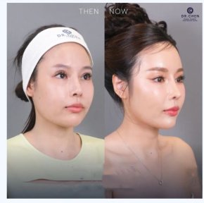 Ultherapy Vorher-Nachher-Ergebnis bei Dr. Chen Clinic – sichtbare Gesichtsstraffung