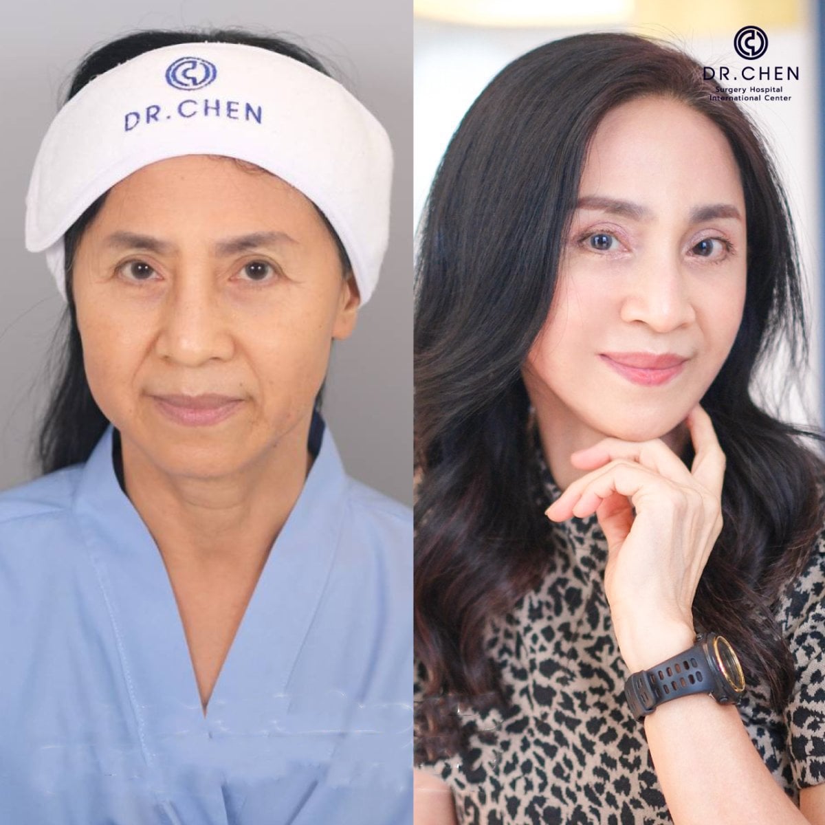 Resultados de lifting facial antes y después en Dr. Chen Clinic, rejuvenecimiento facial