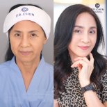 Facelift Vorher-Nachher-Ergebnisse bei Dr. Chen Clinic, verjüngtes Aussehen