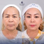 Vorher-nachher-Ergebnis der Blepharoplastik in der Dr. Chen Clinic, Lidkorrektur