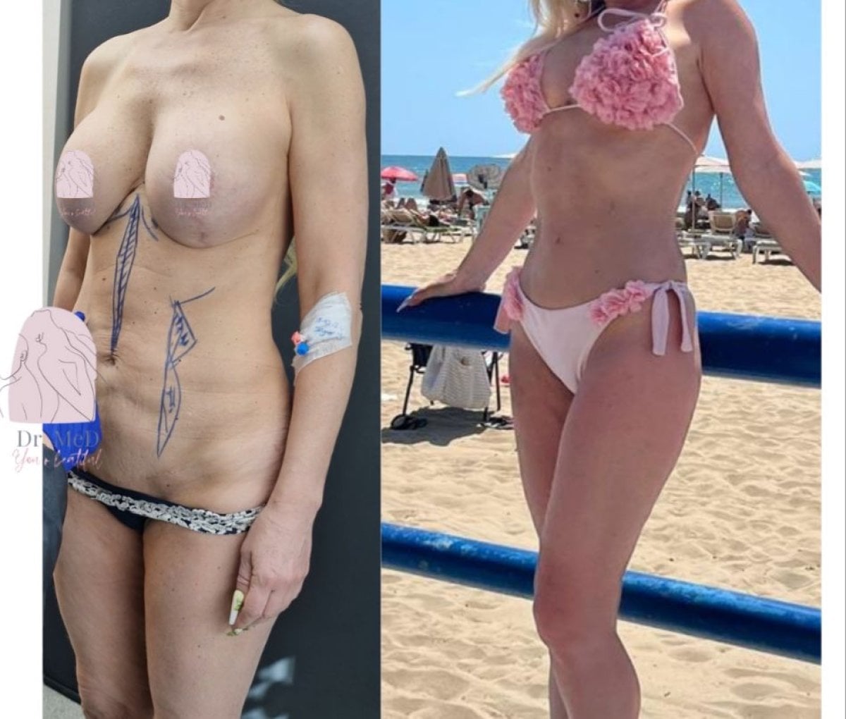 Resultados de lifting corporal completo antes y después en Dr. MED, mejor contorno y piel firme