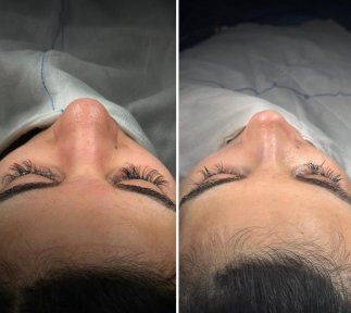 Vorher-nachher-Ergebnis der Revision-Rhinoplastik in der Dr. Safa Manav Klinik, verbesserte Nasenform