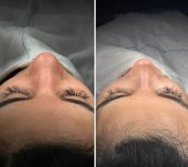 Vorher-nachher-Ergebnis der Revision-Rhinoplastik in der Dr. Safa Manav Klinik, verbesserte Nasenform