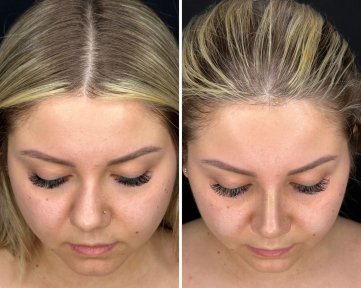 Vorher-nachher-Ergebnis der Revision-Rhinoplastik in der Dr. Safa Manav Klinik, verbesserte Nasenform