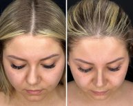 Vorher-nachher-Ergebnis der Revision-Rhinoplastik in der Dr. Safa Manav Klinik, verbesserte Nasenform