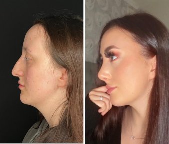 Vorher-nachher-Ergebnis der Revision-Rhinoplastik in der Dr. Safa Manav Klinik, verbesserte Nasenform