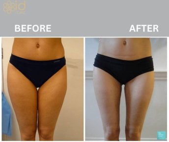 Before and after liposuction results at ID Clinic Bangkok, slimmer thighs and body contour
