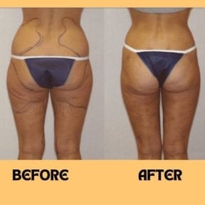Before and after liposuction results at ID Clinic Bangkok, improved body contour and shape