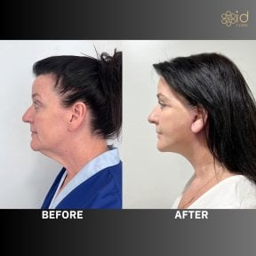 Before and after endoscopic facelift results at ID Clinic Bangkok, visible facial rejuvenation