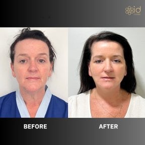 Before and after endoscopic facelift results at ID Clinic Bangkok, facial rejuvenation outcome