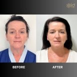 Before and after endoscopic facelift results at ID Clinic Bangkok, facial rejuvenation outcome