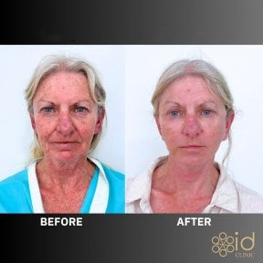 Before and after endoscopic facelift results at ID Clinic Bangkok, visible facial rejuvenation