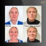 Before and after endoscopic facelift results at ID Clinic Bangkok, visible facial rejuvenation