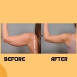 Before and after arm liposuction results at ID Clinic Bangkok – slimmer upper arm contour