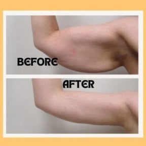 Before and after arm liposuction results at ID Clinic Bangkok, improved arm contour visible