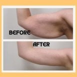 Before and after arm liposuction results at ID Clinic Bangkok, improved arm contour visible