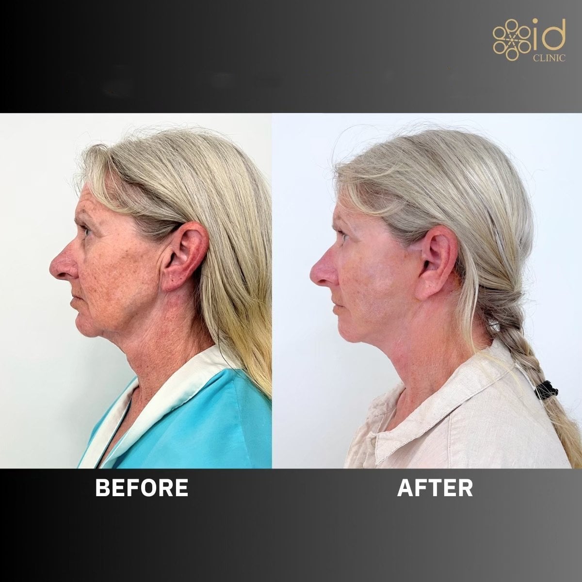 Resultados de lifting de frente antes y después en ID Clinic Bangkok, rejuvenecimiento facial visible