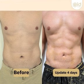Before and after liposuction results at ID Clinic Bangkok, visible abdominal contour improvement
