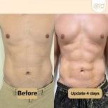 Before and after liposuction results at ID Clinic Bangkok, visible abdominal contour improvement