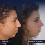 Vorher-nachher-Rhinoplastik-Ergebnis in der Dr. Safa Manav Klinik, Nasenkorrektur nach 2 Monaten