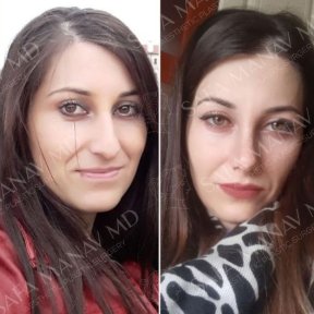 Vorher-nachher-Ergebnis der Revision-Rhinoplastik in der Dr. Safa Manav Klinik, verbesserte Nase