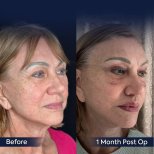 Vorher-nachher-Ergebnis der Brauenlifting bei Dr. Safa Manav Clinic, sichtbare Anhebung