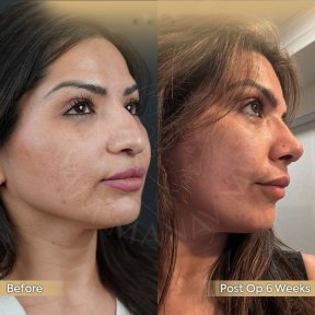 Vorher-nachher-Ergebnis der Revision-Rhinoplastik in der Dr. Safa Manav Klinik, 6 Wochen