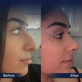 Vorher-nachher-Ergebnisse der Revision-Rhinoplastik in der Dr. Safa Manav Klinik, verbesserte Nasenform