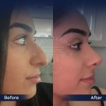 Vorher-nachher-Ergebnisse der Revision-Rhinoplastik in der Dr. Safa Manav Klinik, verbesserte Nasenform
