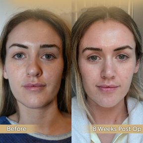 Vorher-nachher-Ergebnis der Revision-Rhinoplastik in der Dr. Safa Manav Klinik, 8 Wochen