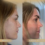 Vorher-nachher-Ergebnis der Revision-Rhinoplastik in der Dr. Safa Manav Clinic, verbesserte Nasenform