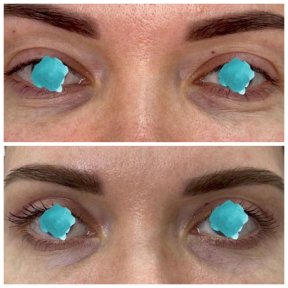 Before and after lower eyelid blepharoplasty results at Altos Clinic, reduced under-eye bags