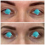 Before and after lower eyelid blepharoplasty results at Altos Clinic, reduced under-eye bags
