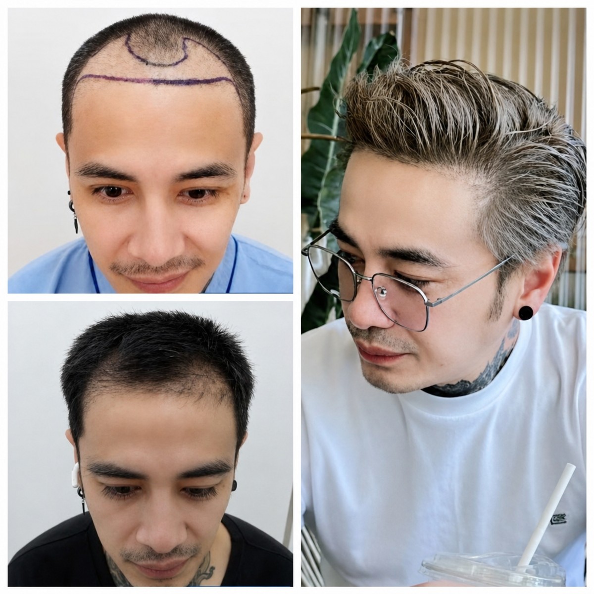 نتائج زراعة الشعر DHI قبل وبعد في قسم الجراحة والتجميل بمستشفى نافامين 9