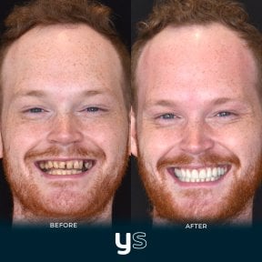Before and after denture results at YeahSmile – restored smile and improved dental aesthetics