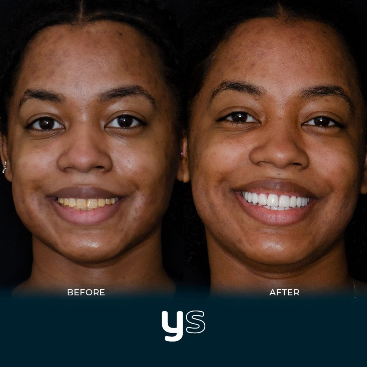 Resultados de dentadura antes y después en YeahSmile: sonrisa mejorada y dientes más blancos