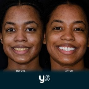 قبل وبعد تركيب تيجان الأسنان في YeahSmile، تحسين ملحوظ في الابتسامة