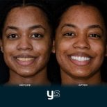 قبل وبعد تركيب تيجان الأسنان في YeahSmile، تحسين ملحوظ في الابتسامة