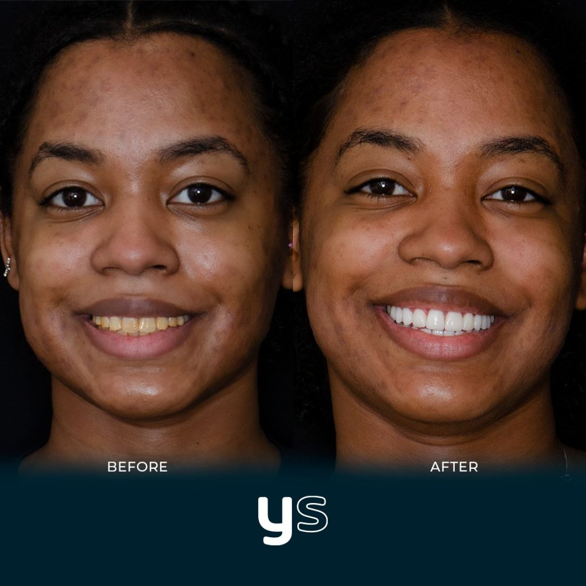 Antes y después de coronas de zirconia en YeahSmile: sonrisa más blanca y natural