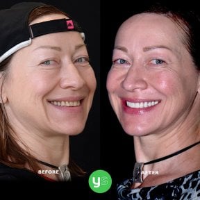 Before and after zirconia crown installation at YeahSmile – visible smile transformation result