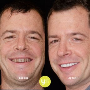 Before and after zirconia crown installation at YeahSmile – visible smile transformation result