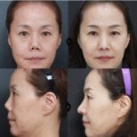 Результаты до и после подтяжки лица в VG Plastic Surgery, омоложение и улучшение контура