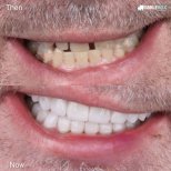 Vorher-nachher-Ergebnis Zahnkronen bei SmileBox Dental Clinic - Thonglor, Sukhumvit