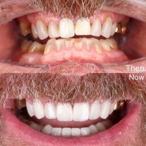 Vorher-nachher-Ergebnis Zahnkronen bei SmileBox Dental Clinic - Thonglor, Sukhumvit