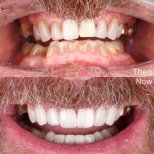 Vorher-nachher-Ergebnis Zahnkronen bei SmileBox Dental Clinic - Thonglor, Sukhumvit